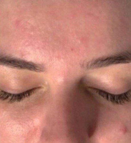 Stirnpartie nach der Hydrafacial-Behandlung, deutlich ruhiger