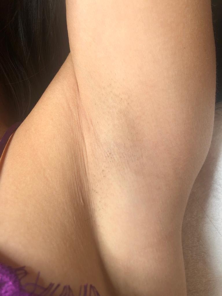 Achsel nach mehreren Sitzungen Laserhaarentfernung bei Body Couture