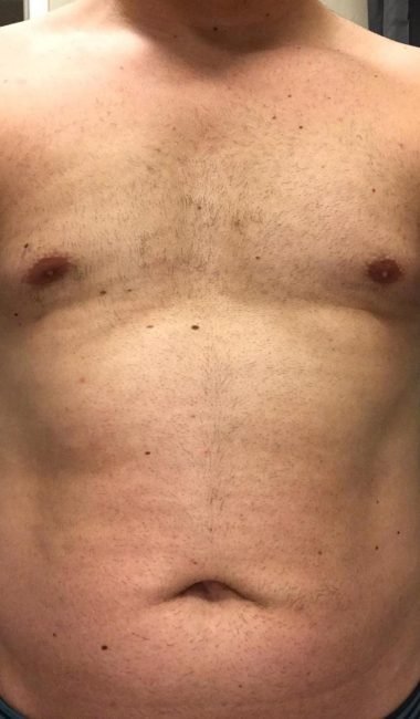 Männerbrust nach mehreren Sitzungen Laserhaarentfernung