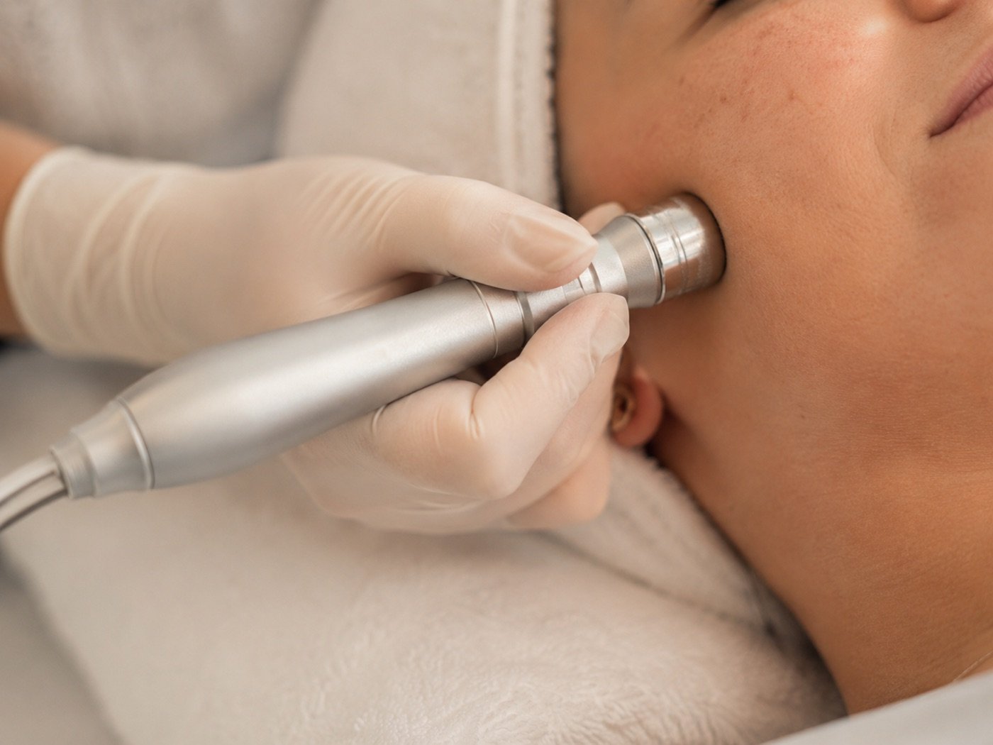 Das Handstück der Mikrodermabrasion in Nahaufnahme an der Wange