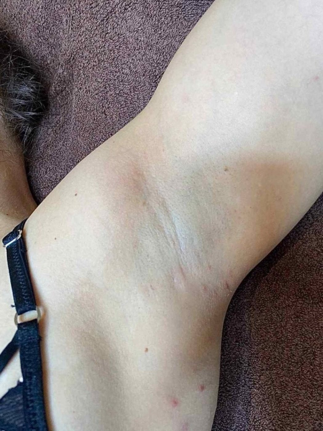 Achsel nach der Laserhaarentfernung bei Body Couture
