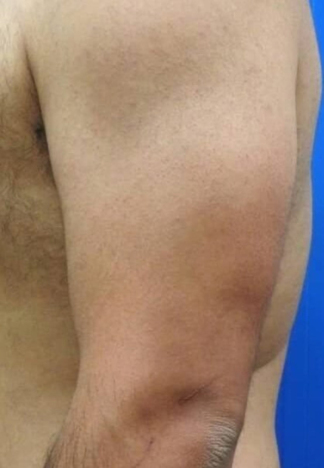 Arm nach der Laserhaarentfernung bei Body Couture