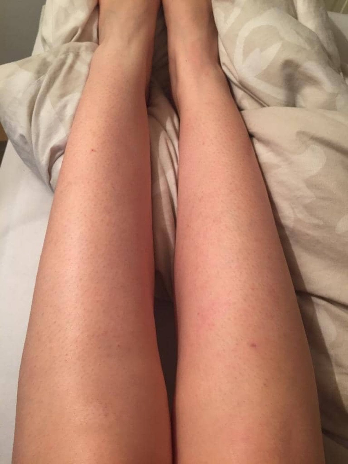 Beine nach mehreren Laserbehandlungen bei Body Couture