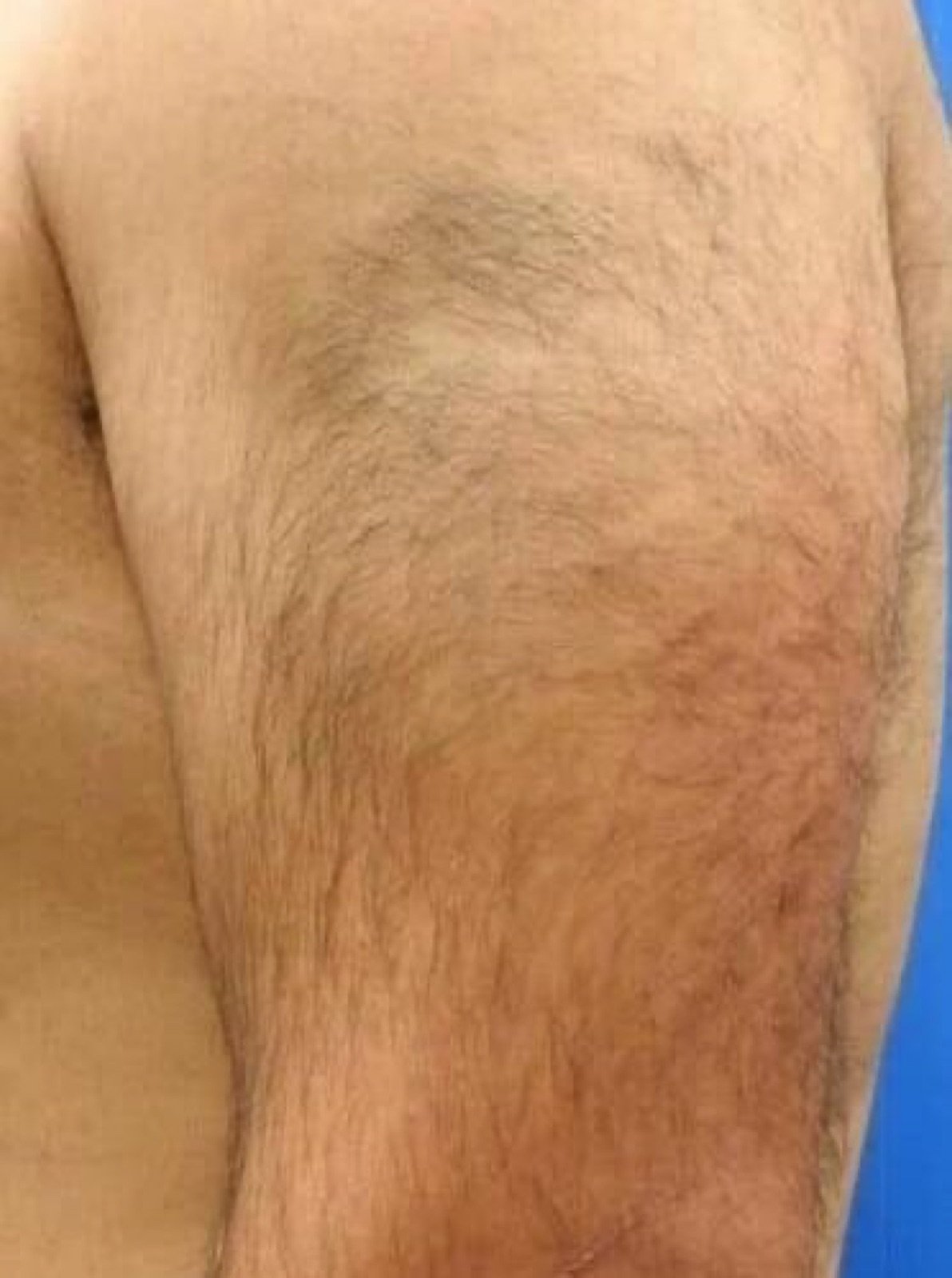 Derselbe Arm vor der Behandlung